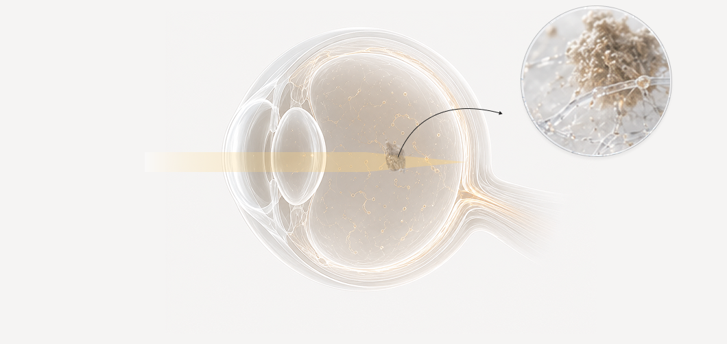 Cross-section of the eye showing light meeting a vitreous collagen clump